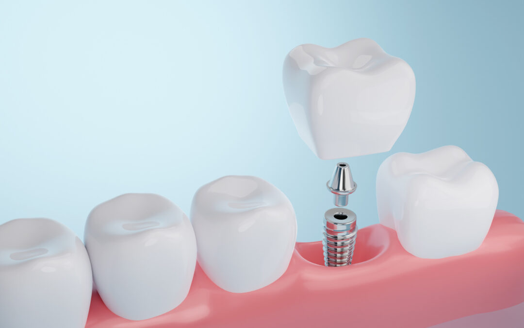 Sedation Dentistry for Dental Implant Surgery: What to Expect