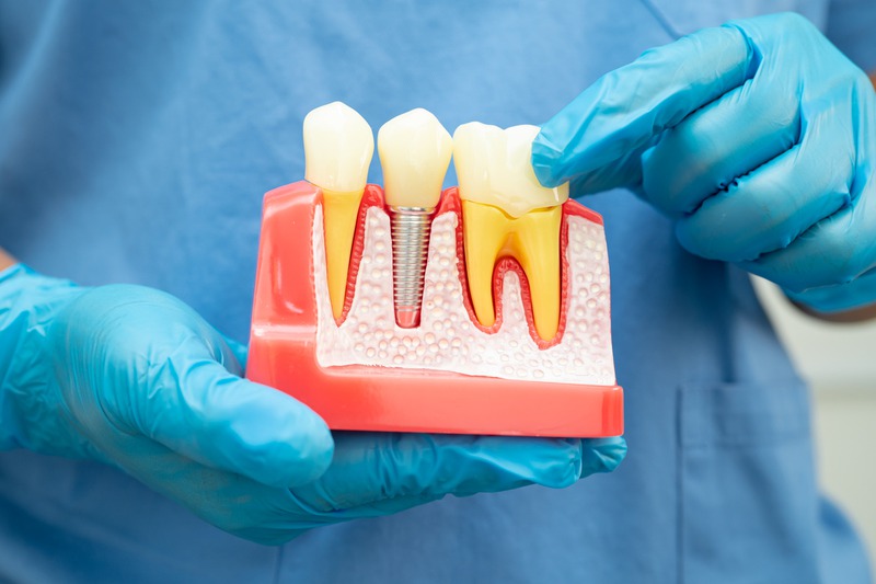 What Are Common Misconceptions About Dental Implants?